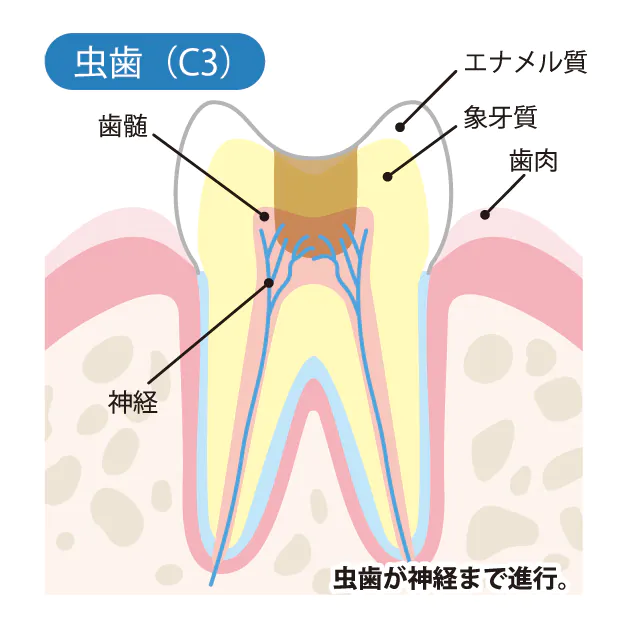 むし歯の進行と治療方法 C3