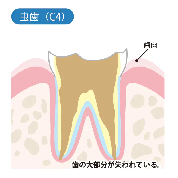 むし歯の進行と治療方法 C4