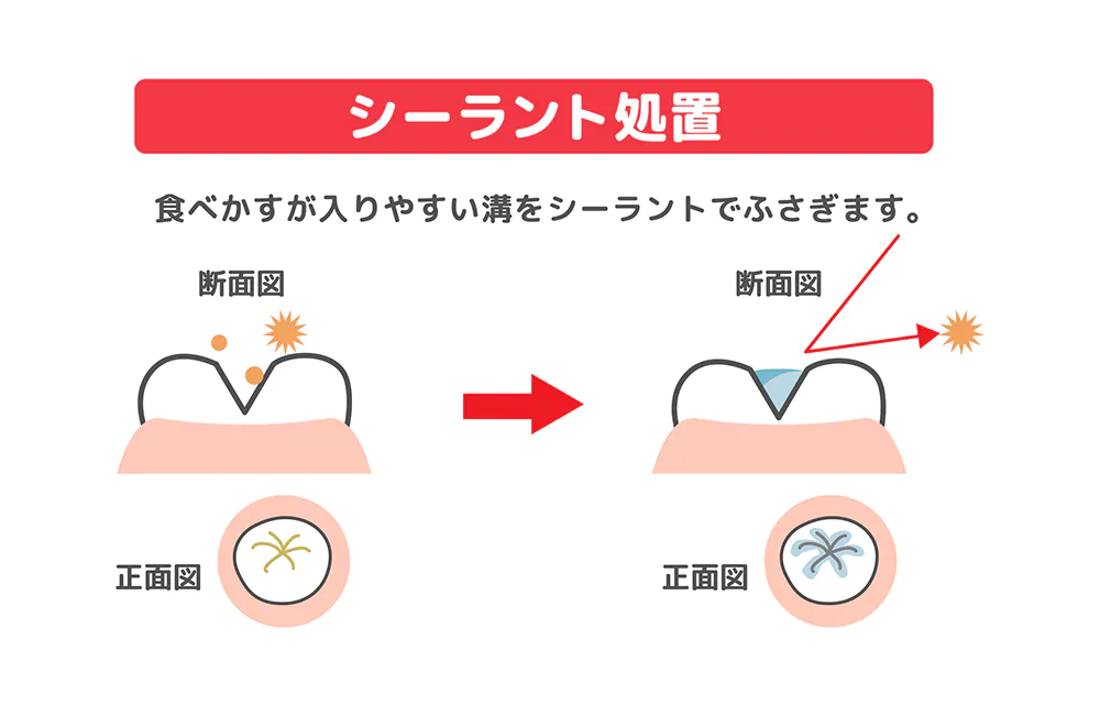 シーラントで溝を埋める