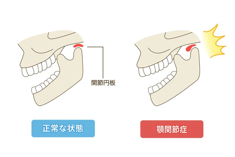 顎関節症