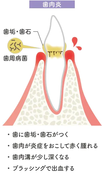歯肉炎