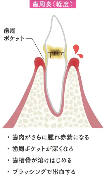 軽度の歯周病