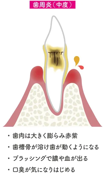 中度の歯周病