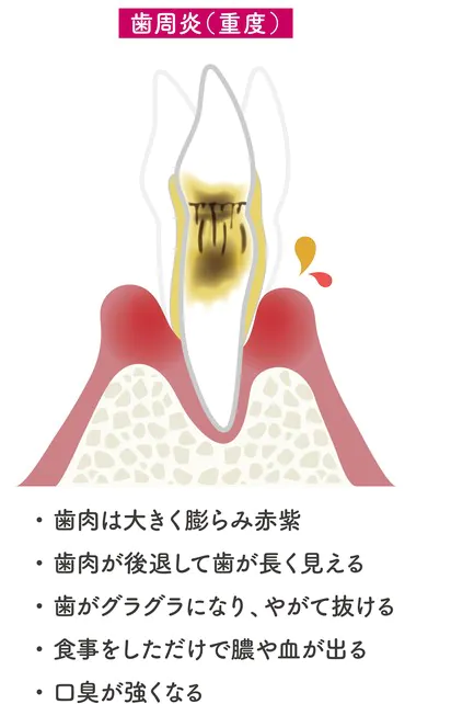 重度の歯周病