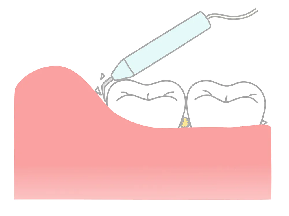 スケーリング（歯石取り）